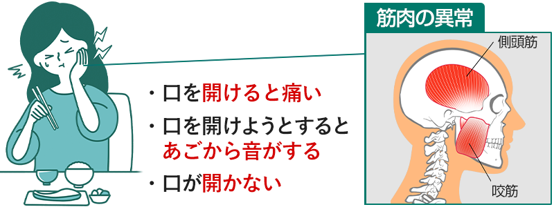 顎関節症のイメージ