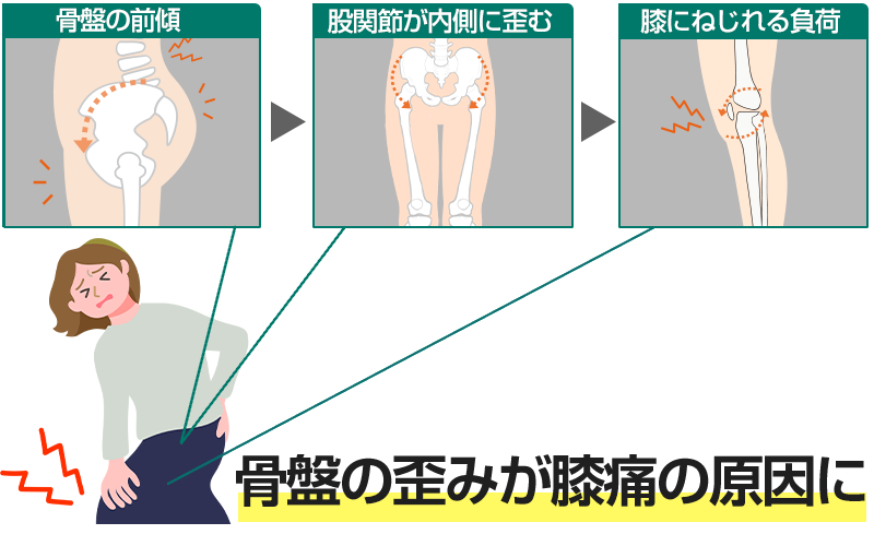 膝痛が起きるイメージ