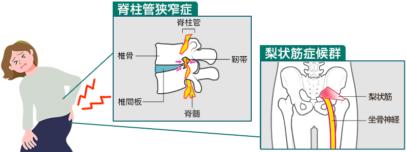 脊柱管狭窄症と梨状筋症候群のイメージ